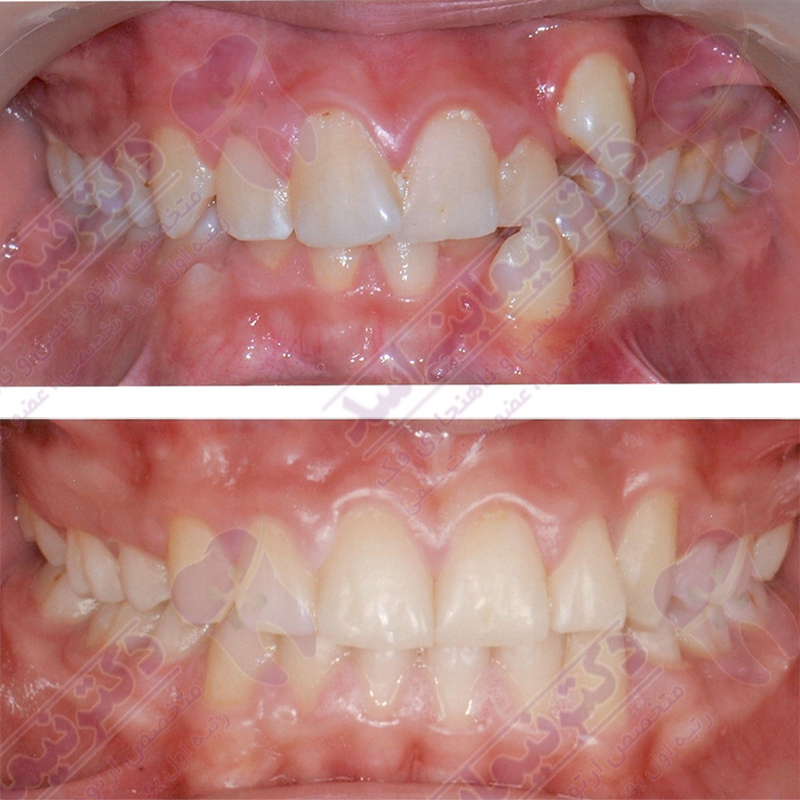 ارتودنسی ثابت با کشیدن دندان