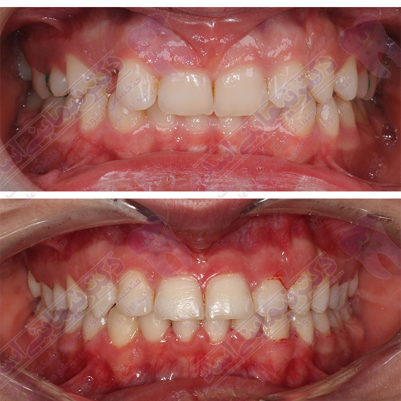 ارتودنسی ثابت بدون کشیدن دندان