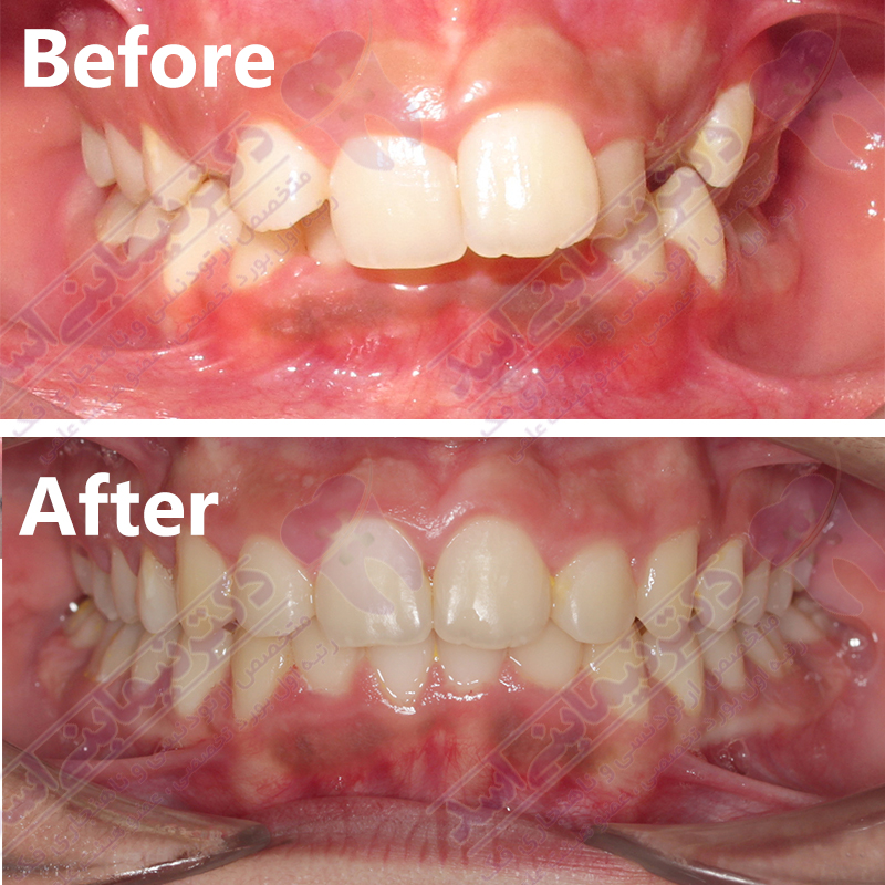 قبل و بعد ارتودنسی – نمونه ارتودنسی ثابت شماره 10