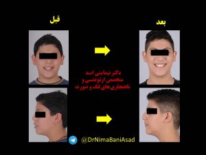 تصاویر ارتودنسی بدون کشیدن دندان