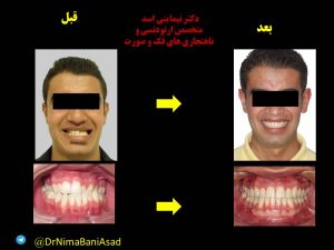 ارتودنسی بدون کشیدن دندا