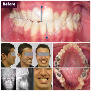قبل و بعد ارتودنسی - نمونه ارتودنسی ثابت شماره 9