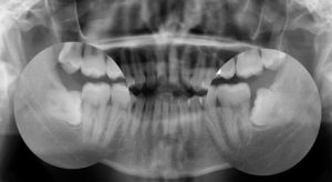 دندان عقل و ارتودنسی