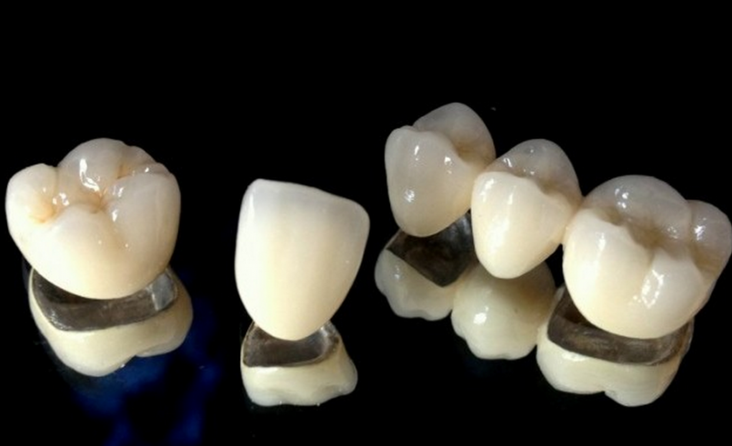تداخل روکش دندان با درمان ارتودنسی