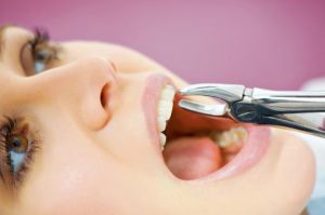 کشیدن دندان برای درمان ارتودنسی