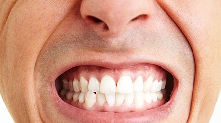 درمان ارتودنسی برای دندان قروچه