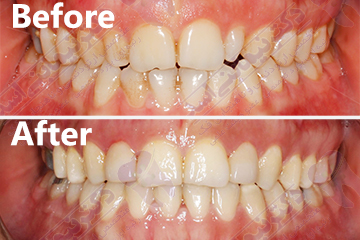بیمار۲۵ساله با نامرتبی دندان های بالا و پایین و بدشکلی دندانهای لترال بالا(پیشین کناری)