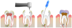 عصب کشی دندان دارای چه مراحلی است؟
