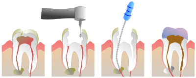 عصب کشی دندان دارای چه مراحلی است؟