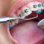 5 دلیل ارتودنسی