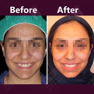 نمونه ارتودنسی ثابت شماره 30
