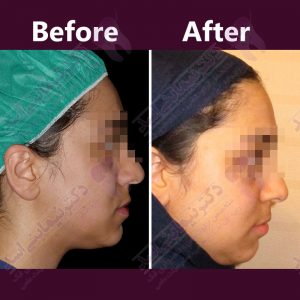 نمونه ارتودنسی ثابت شماره 30