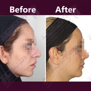 نمونه ارتودنسی ثابت شماره 32