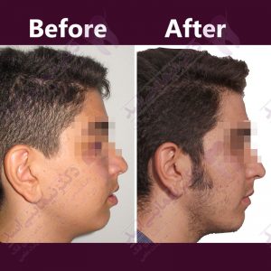 نمونه ارتودنسی ثابت شماره 31