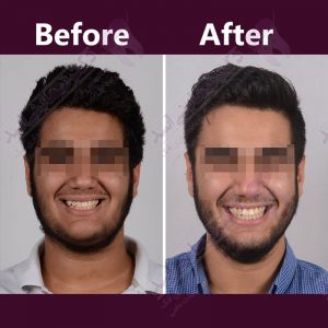 نمونه ارتودنسی ثابت شماره 35