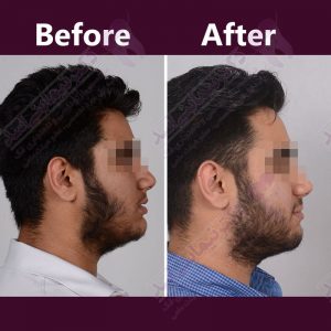 نمونه ارتودنسی ثابت شماره 35