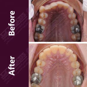 نمونه ارتودنسی ثابت شماره 35