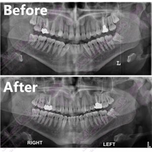 نمونه ارتودنسی ثابت شماره 35