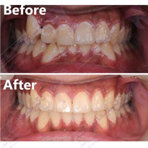 نمونه ارتودنسی ثابت شماره 35