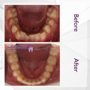 نمونه ارتودنسی ثابت شماره 45