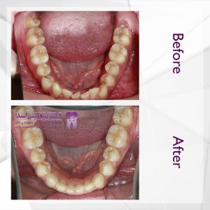 نمونه ارتودنسی ثابت شماره 46