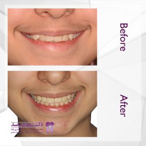نمونه ارتودنسی ثابت شماره 47
