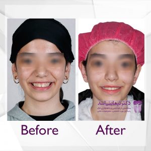 نمونه ارتودنسی ثابت شماره 50