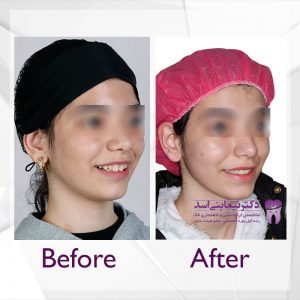 نمونه ارتودنسی ثابت شماره 50