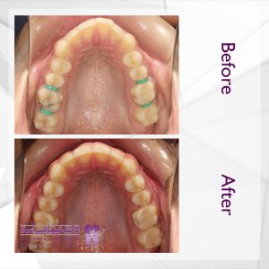 نمونه ارتودنسی ثابت شماره 51
