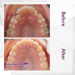 نمونه ارتودنسی ثابت شماره 53
