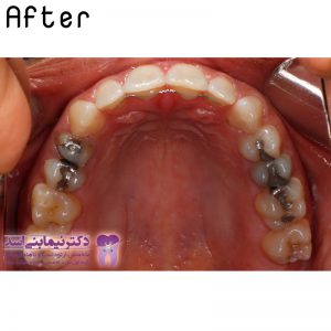 نمونه ارتودنسی ثابت شماره 48