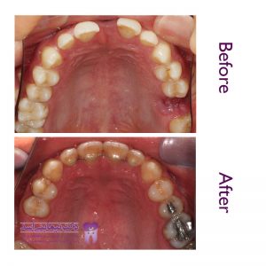 نمونه ارتودنسی ثابت شماره 56