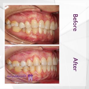 نمونه ارتودنسی ثابت شماره 55