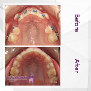 نمونه ارتودنسی ثابت شماره 58