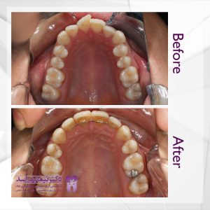نمونه ارتودنسی ثابت شماره 57