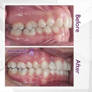 نمونه ارتودنسی ثابت شماره 59