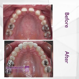 نمونه ارتودنسی ثابت شماره 59