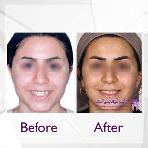 نمونه ارتودنسی ثابت شماره 60