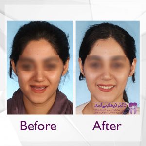 نمونه ارتودنسی ثابت شماره 62