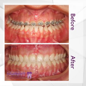 نمونه ارتودنسی ثابت شماره 62