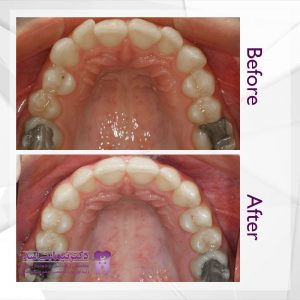 نمونه ارتودنسی ثابت شماره 63