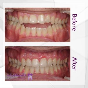نمونه ارتودنسی ثابت شماره 65
