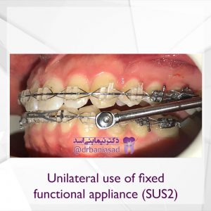 نمونه ارتودنسی ثابت شماره 68