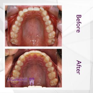 نمونه ارتودنسی ثابت شماره 68