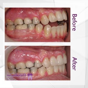 نمونه ارتودنسی ثابت شماره 65