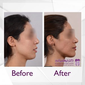 نمونه ارتودنسی ثابت شماره 64