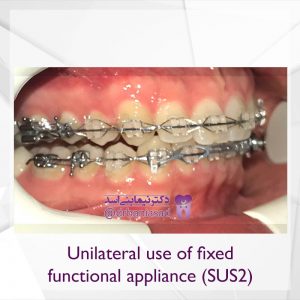 نمونه ارتودنسی ثابت شماره 68
