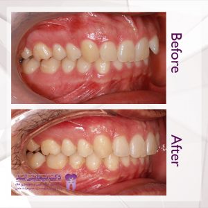 نمونه ارتودنسی ثابت شماره 68