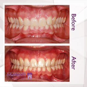 نمونه ارتودنسی ثابت شماره 68