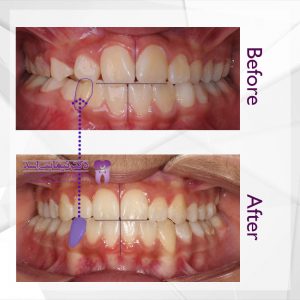 نمونه ارتودنسی ثابت شماره 72